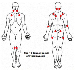 Fibromyalgia can be diagnosed by identifying tender points on the body